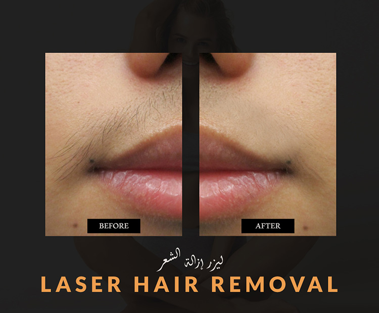 Laser Hair Removal Upper Lips