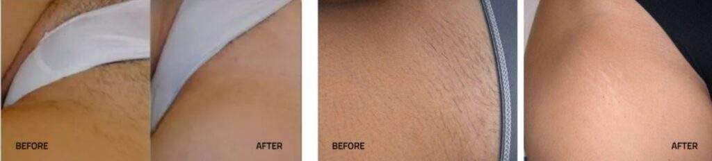 Bikini laser hair removal before and after