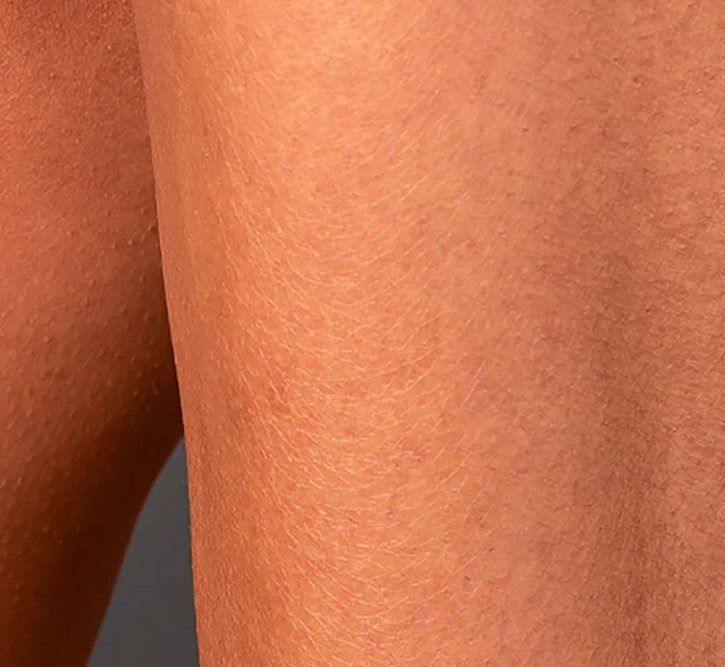 Laser Hair Removal After 2