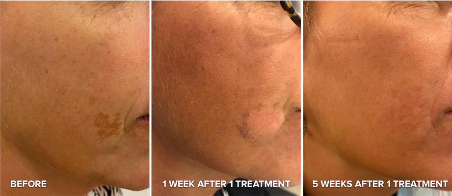 Permanent Laser Hair Removal