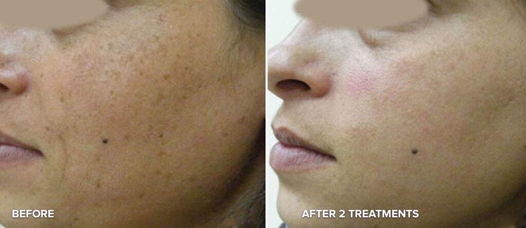 Full Face Laser Hair Removal Before and after