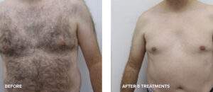 Laser Hair Removal Before and after