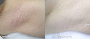 Laser Hair removal bikini before and after