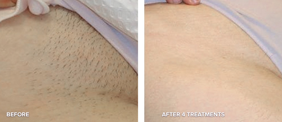 Bikini Laser Hair Removal